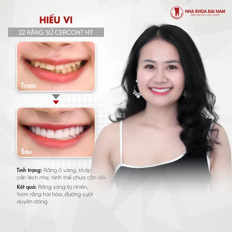 Răng sứ Cercon – Ưu điểm, Quy trình, Chi phí điều trị