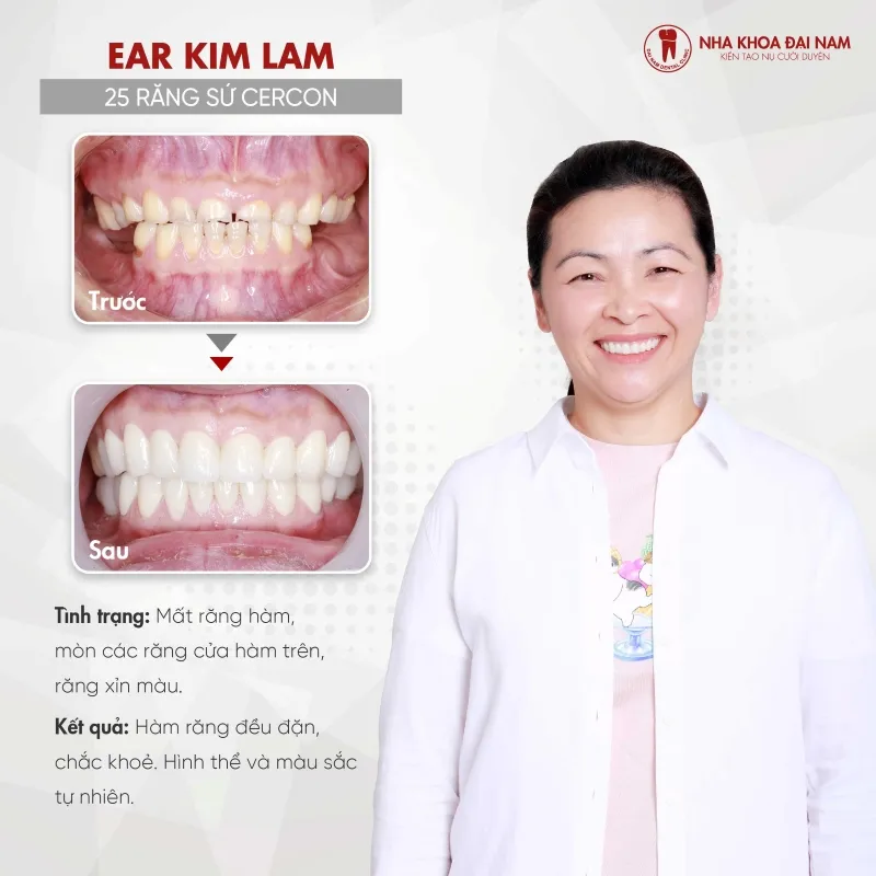 Răng sứ Cercon – Ưu điểm, Quy trình, Chi phí điều trị