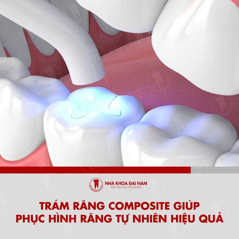Tram rang composite la phuong phap phuc hinh rang hu ton hien dai hieu qua