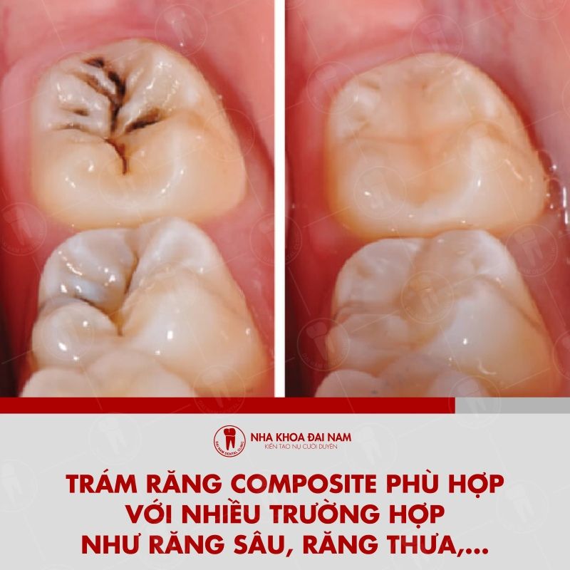 Tram rang Composite phu hop voi nhieu truong hop nhu rang sau rang thua mon co chan rang