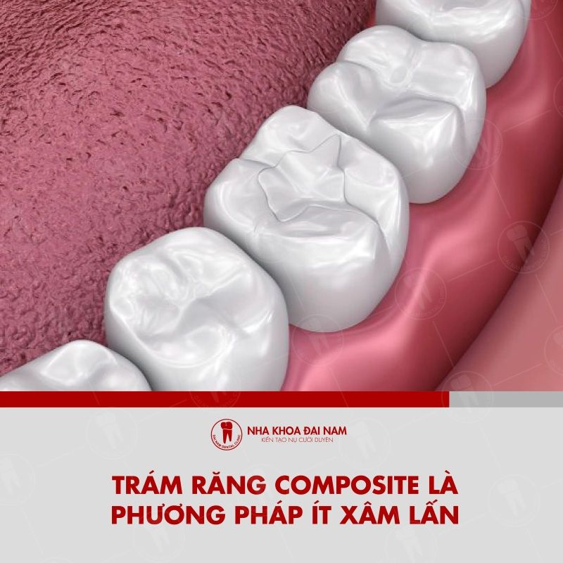 Tram rang composite la phuong phap it xam lan bao ve cau truc rang tu nhien
