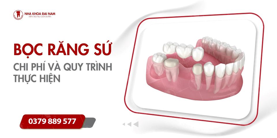 Bọc răng sứ | Giá, Thời Gian, Loại Sứ Tốt Và Quy Trình