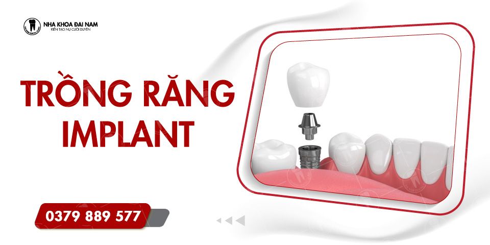 Quy trình trồng răng Implant & Chi phí cấy Implant