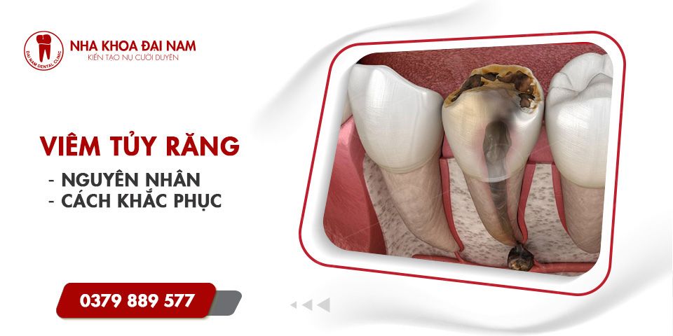 Viêm tủy răng | Nguyên nhân, cách khắc phục hiệu quả