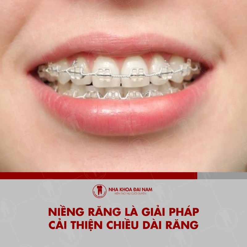 Nieng rang la giai phap cai thien chieu dai rang
