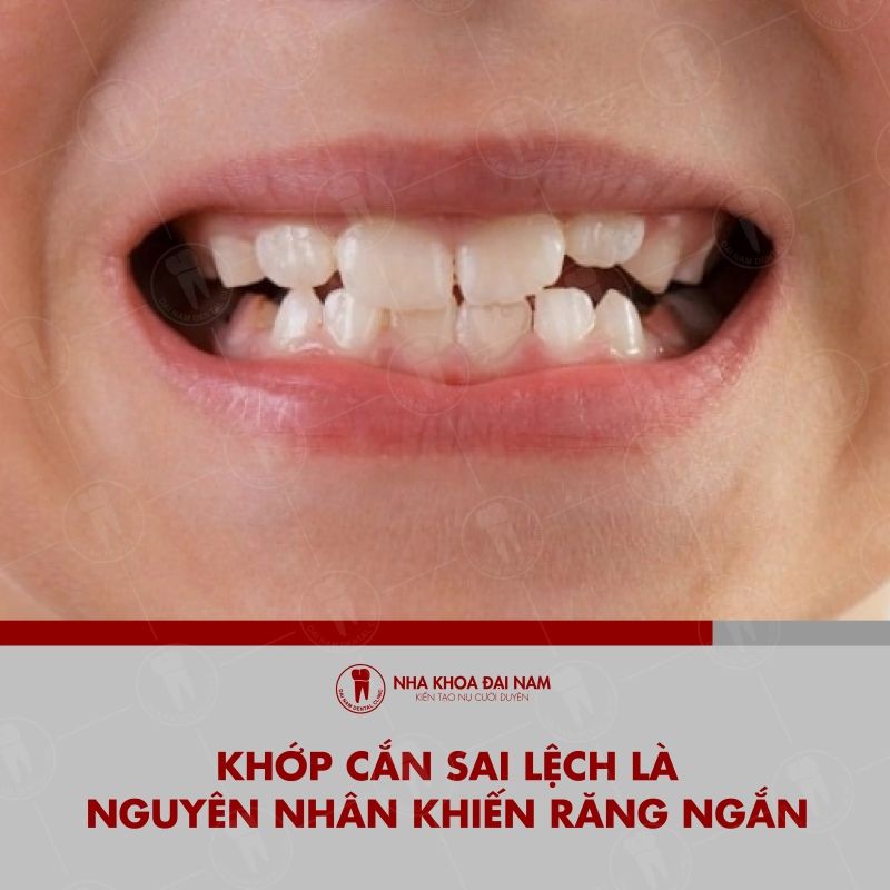Khop can sai lech la nguyen nhan khien rang ngan