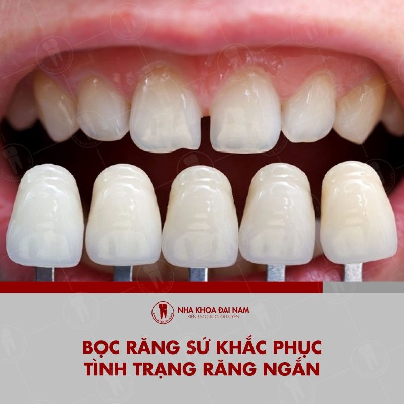 Boc rang su khac phuc tinh trang rang ngan