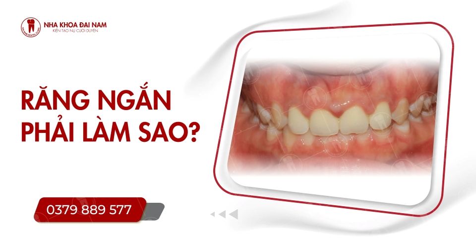 Răng ngắn phải làm sao? Tướng số của người răng ngắn