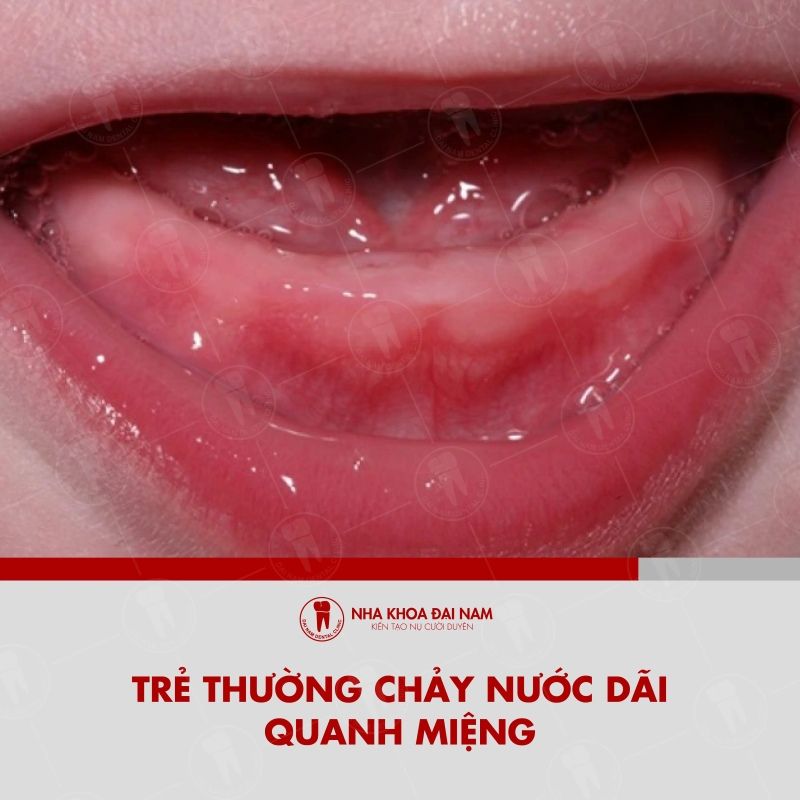 Nhung bieu hien khi tre sot moc rang