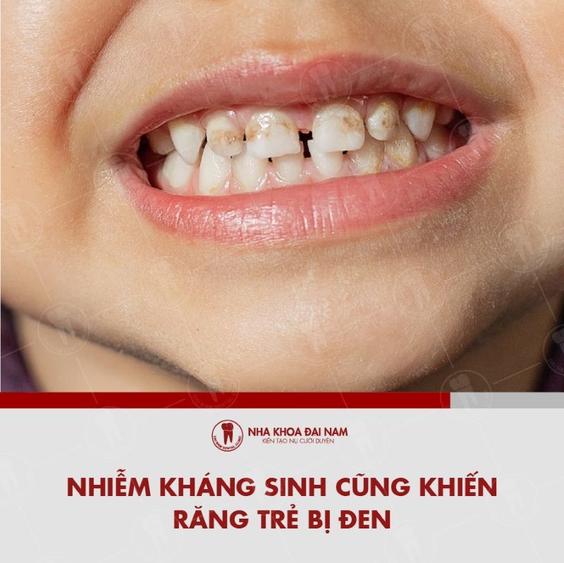 Nhiem khang sinh cung khien rang tre bi den