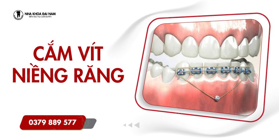 Cắm vít niềng răng là gì? Khi nào cần cắm vít niềng răng?