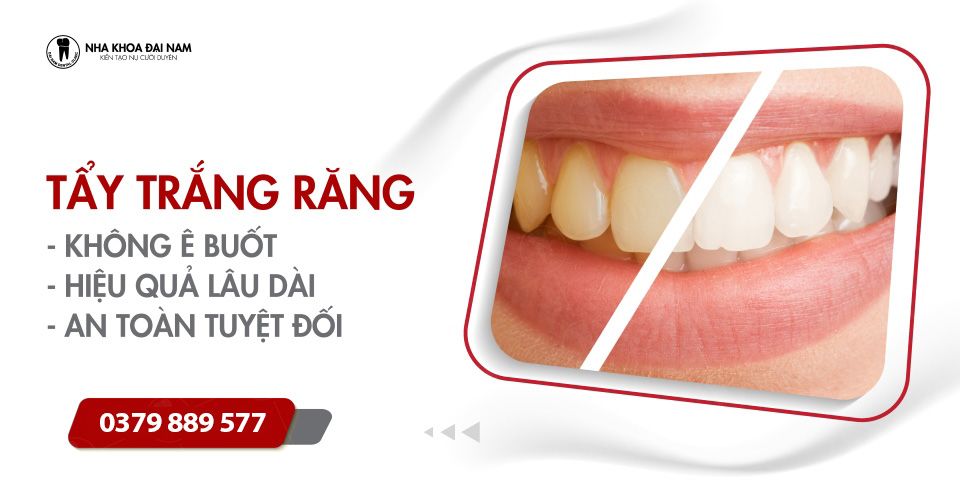 Tẩy trắng răng: Phương pháp thực hiện, Chi phí và Quy trình tẩy trắng