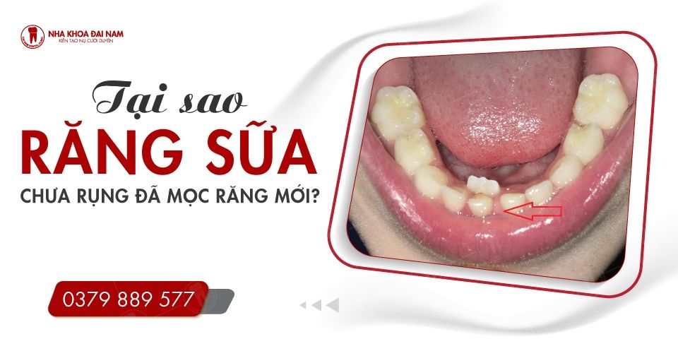Tại sao răng sữa chưa rụng đã mọc răng mới ?