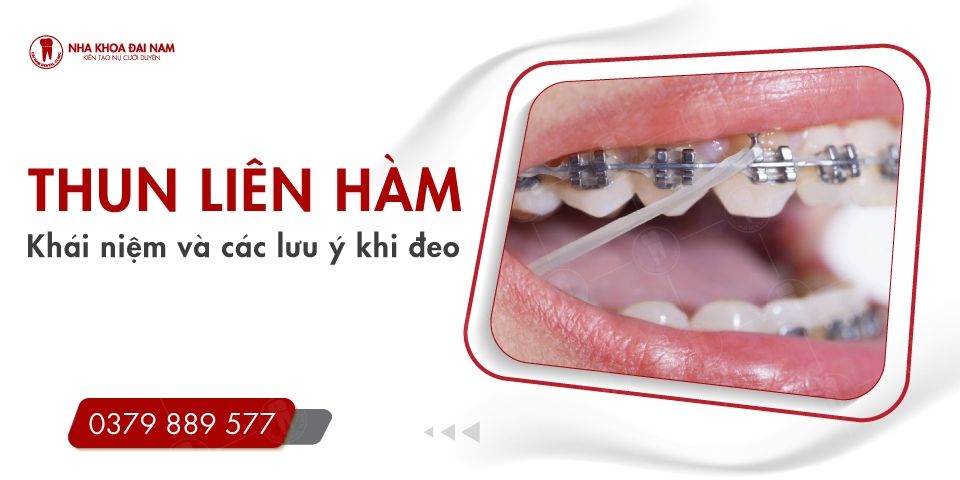 Thun liên hàm là gì? Tại sao phải đeo thun liên hàm khi niềng răng
