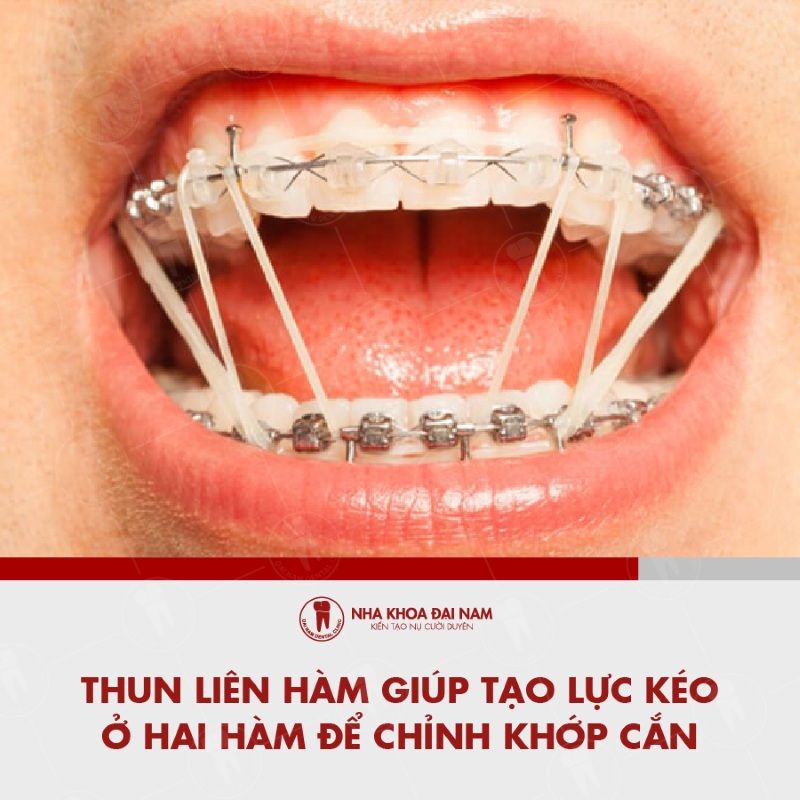 Thun lien ham giup tao luc keo o hai ham de chinh khop can