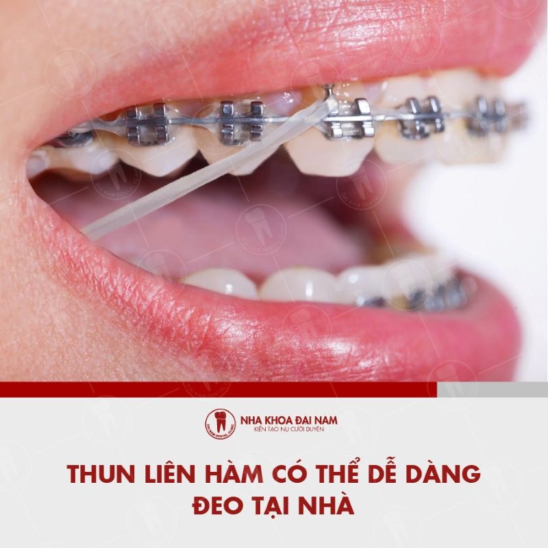 Thun lien ham co the de dang deo tai nha