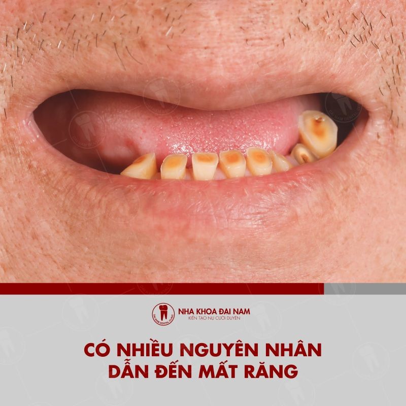 Mat rang co the xay ra o bat ky vi tri nao va nhieu nguyen nhan khac nhau