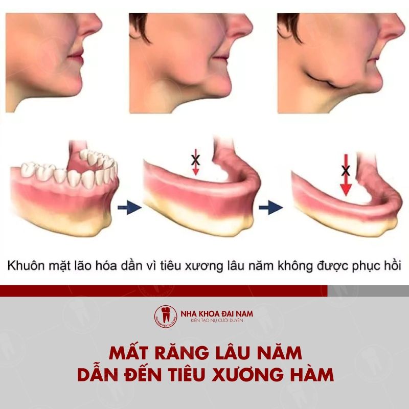 Mat rang lau nam dan den tieu xuong ham