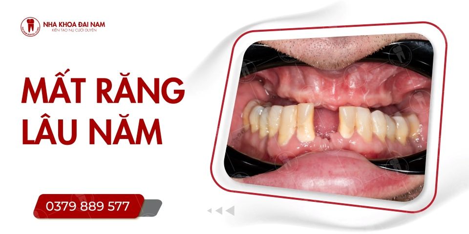 Mất răng lâu năm có trồng được không? Phương pháp nào tốt nhất?