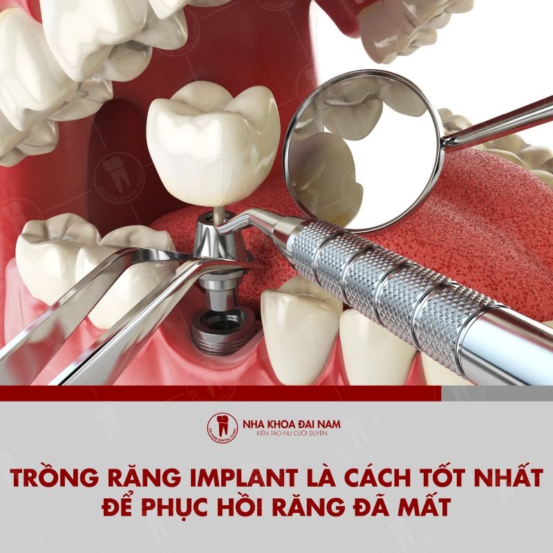 Trong rang Implant la giai phap phuc hinh rang da mat tot nhat the gioi