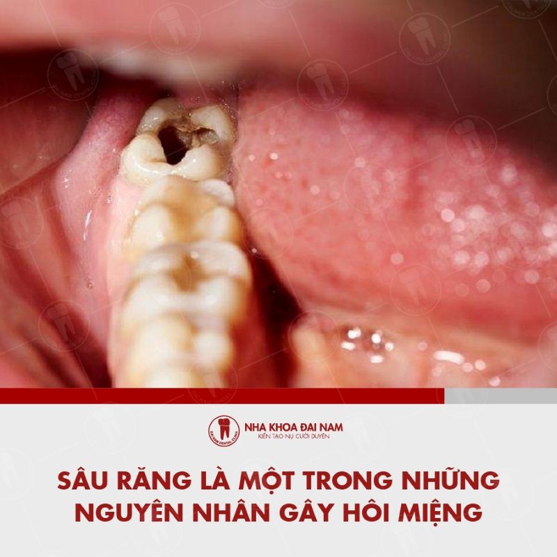Sau rang la mot trong nhung nguyen nhan gay hoi mieng
