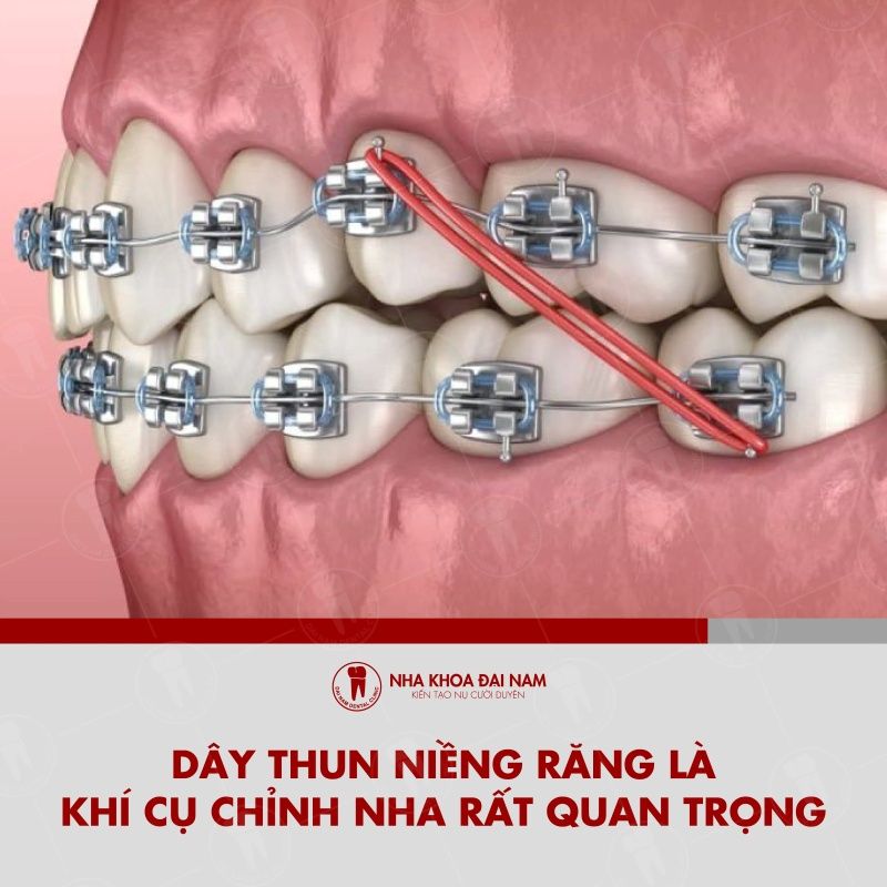 Day thun nieng rang la khi cu chinh nha rat quan trong