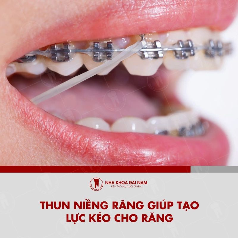Thun nieng rang ho tro tao them luc ket hop len cac rang