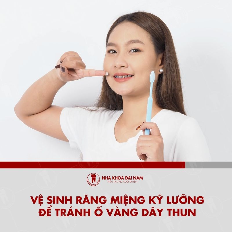 Can ve sinh rang mieng ky luong de tranh tinh trang day thun o vang