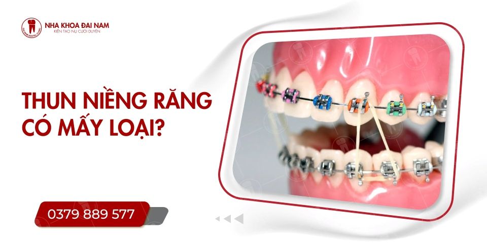 Dây thun niềng răng có tác dụng gì? Hướng dẫn cách sử dụng