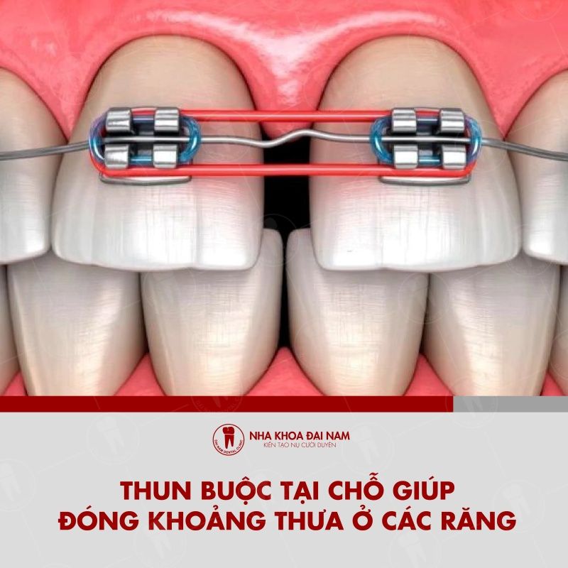 Thun buoc tai cho giup dong khoang thua o cac rang