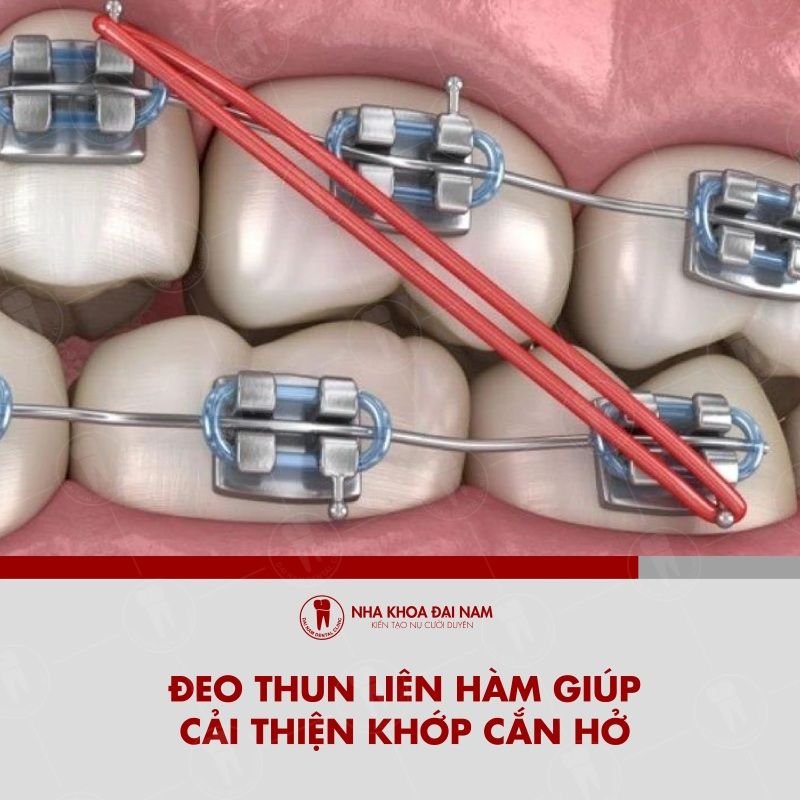 Deo thun lien ham giup cai thien khop can bi ho