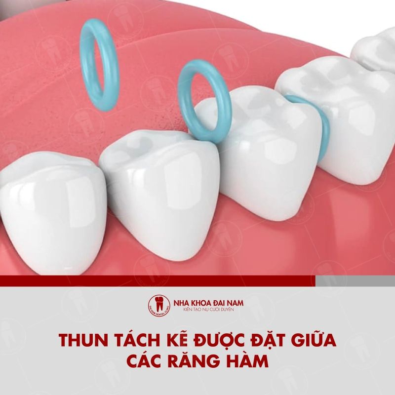 Thun tach ke duoc dat giua cac rang