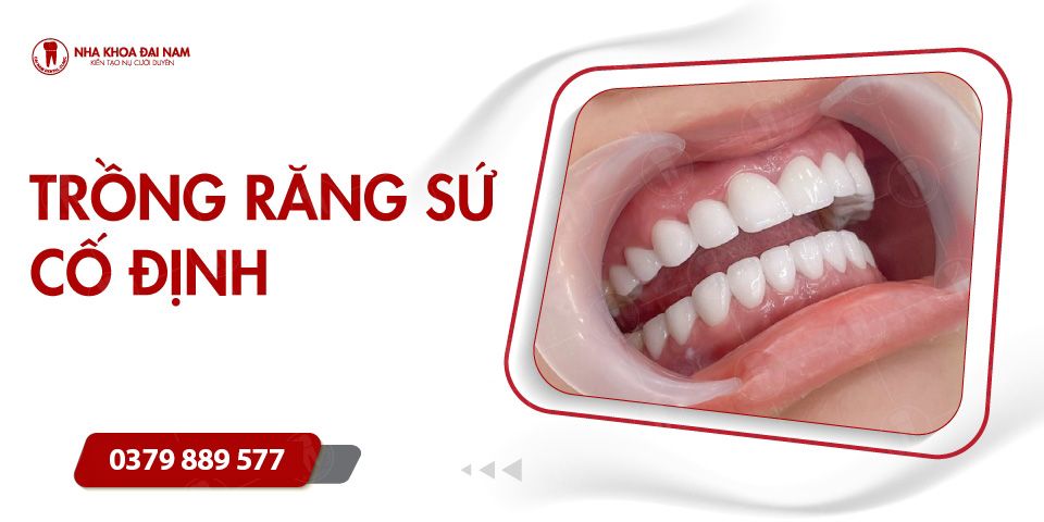 Trồng răng sứ cố định - Chi phí điều trị bao nhiêu?