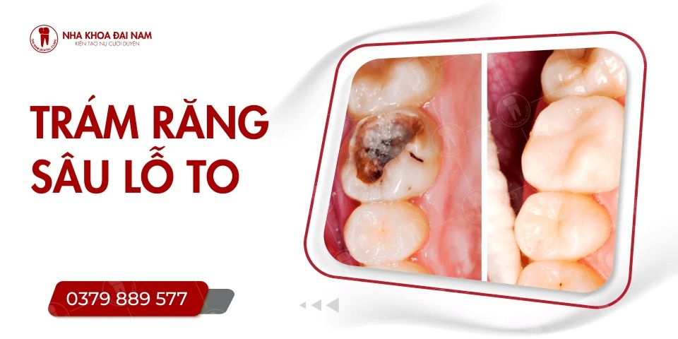Trám răng sâu lỗ to bao nhiêu tiền? Có đau hay không?