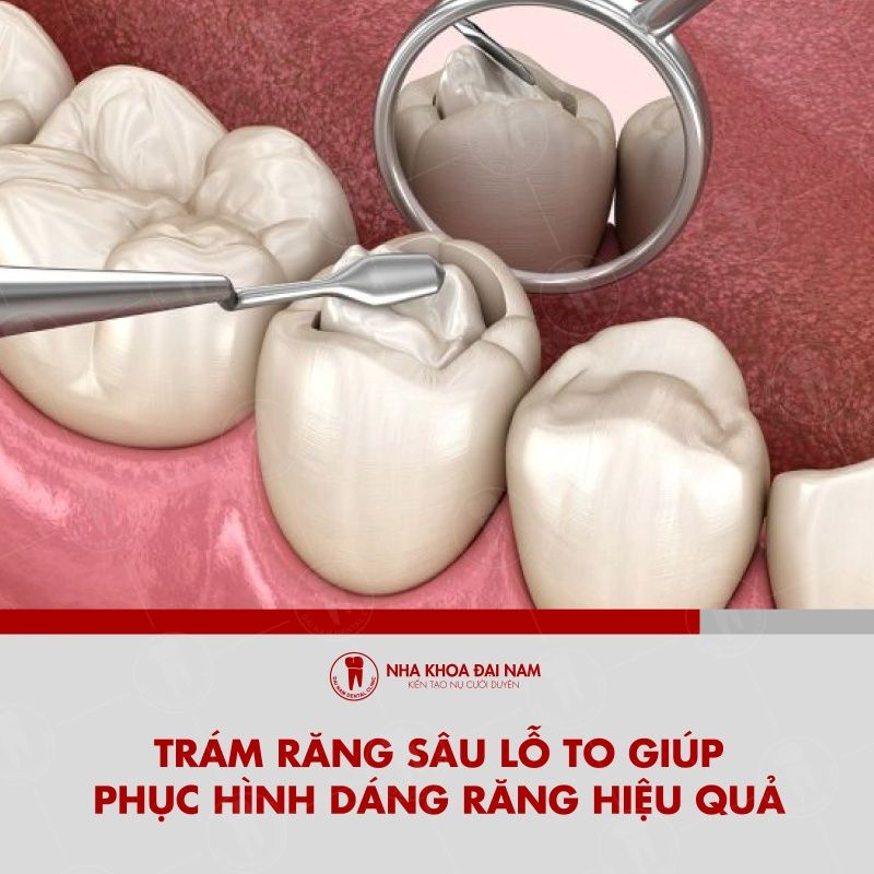 Tram rang giup phuc hinh dang rang ban dau hieu qua