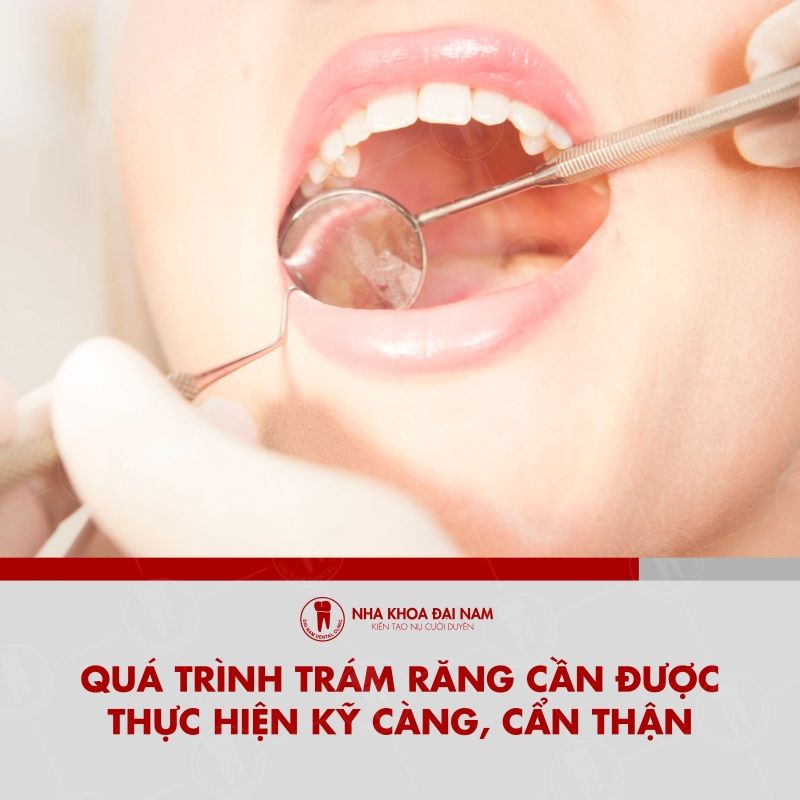Qua trinh tram rang sau can duoc thuc hien ky can than