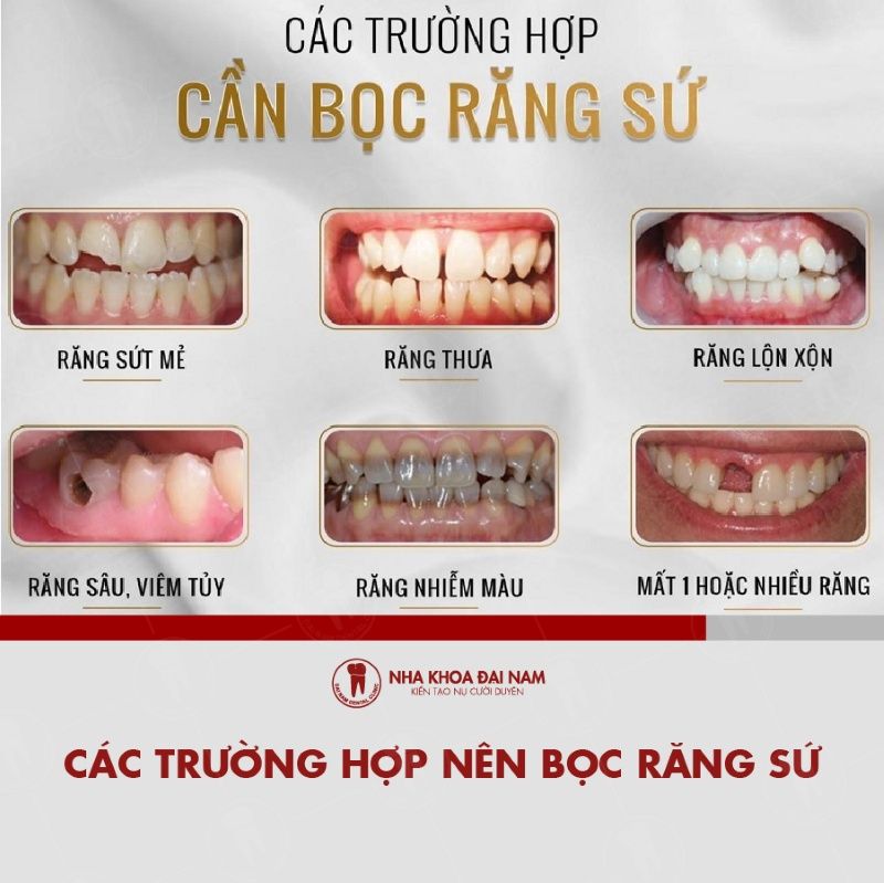 Cac truong hop can boc rang su de phuc hinh rang