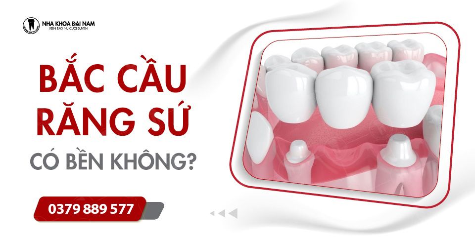 BẮC CẦU RĂNG SỨ CÓ BỀN KHÔNG? ƯU VÀ NHƯỢC ĐIỂM CỦA CẦU RĂNG SỨ