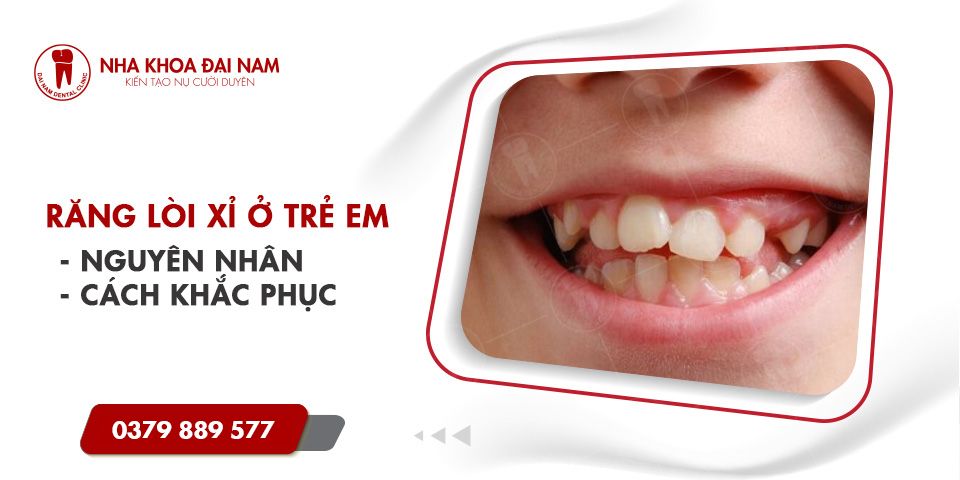 Răng lòi xỉ ở trẻ em | Nguyên nhân và Cách điều trị hiệu quả