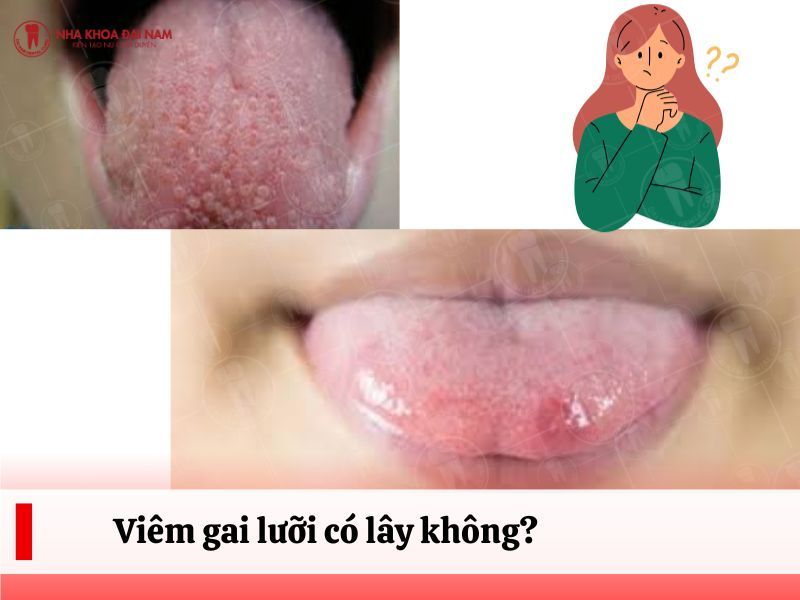 Viem gai luoi khong phai la benh truyen nhiem khong lay tu nguoi nay sang nguoi khac