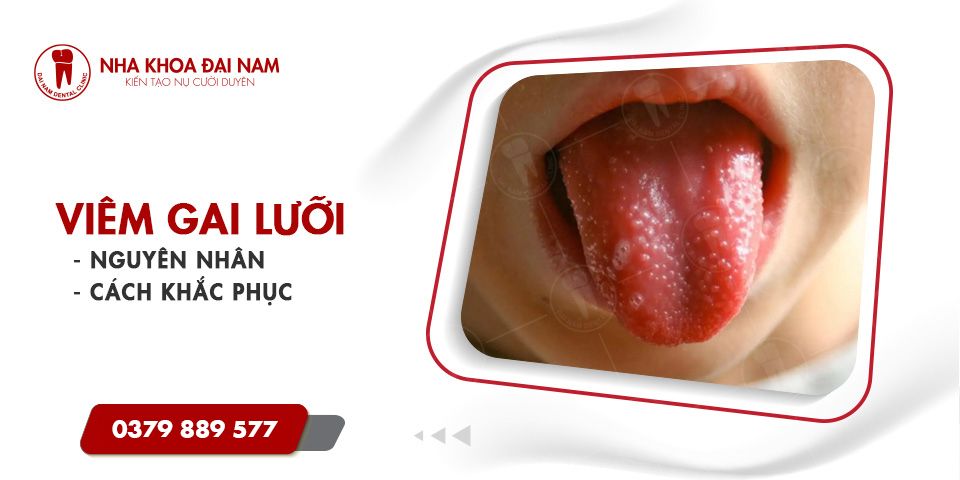 Viêm Gai Lưỡi - Nguyên nhân, Dấu hiệu và Cách điều trị