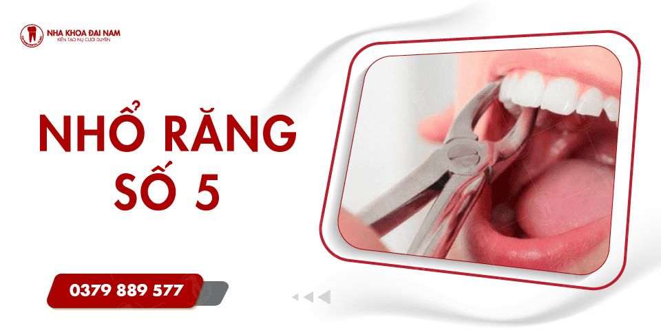 Nhổ Răng Số 5 Khi Nào? Chi Phí và Các Lưu Ý Quan Trọng