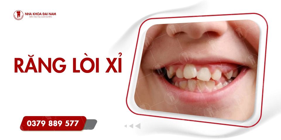 Răng lòi xỉ là gì? Cách khắc phục tình trạng này hiệu quả