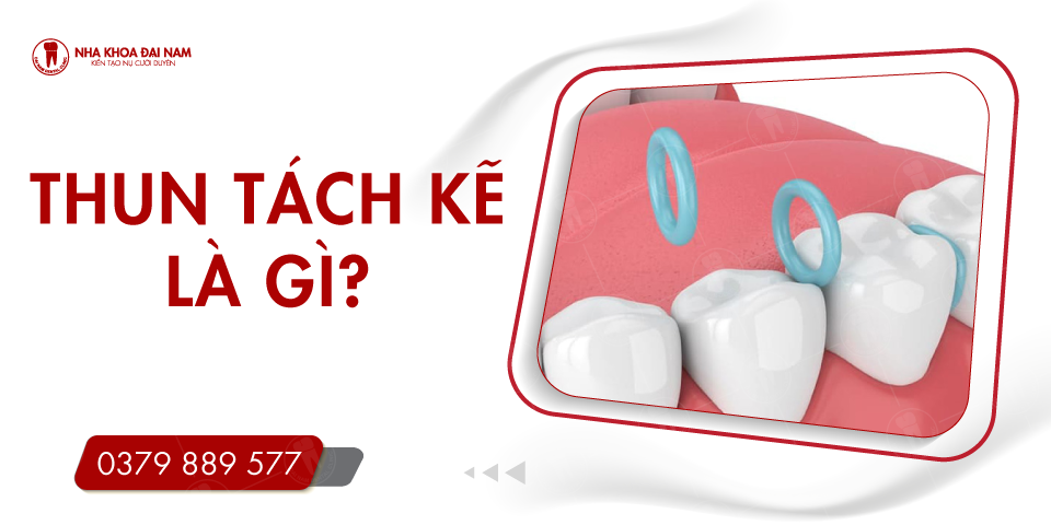 ĐẶT THUN TÁCH KẼ ĐỂ LÀM GÌ? CÓ ĐAU KHÔNG? THỜI GIAN BAO LÂU?