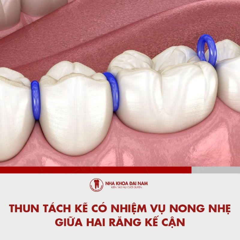 Thun tach ke co nhiem vu tao khoang cach giua hai rang
