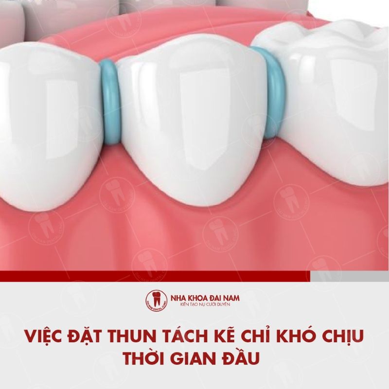 Viec dat thun tach ke chi kho chiu thoi gian dau