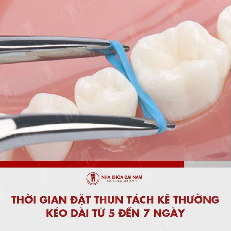 Thoi gian dat thun tach ke thuong keo dai tu 5 den 7 ngay