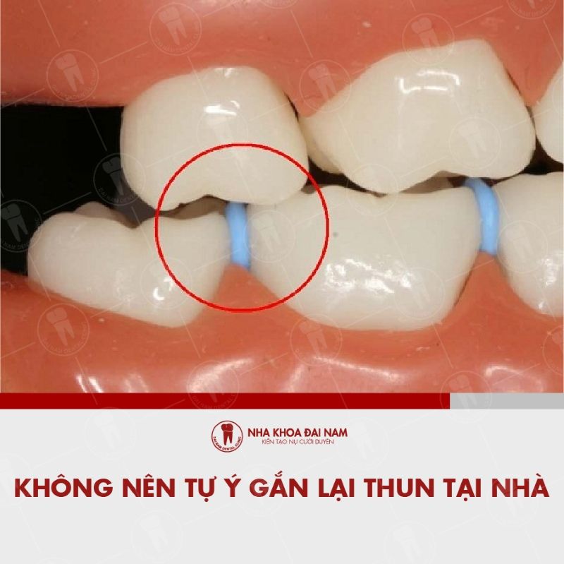 Khong nen tu y gan lai thun tai nha