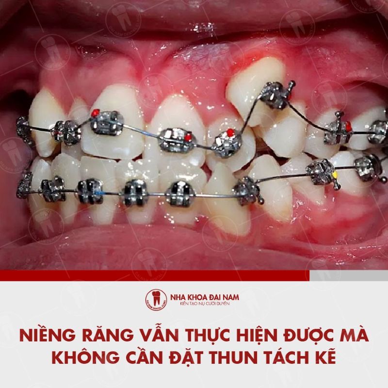 Nieng rang van thuc hien duoc ma khong can dat thun tach ke