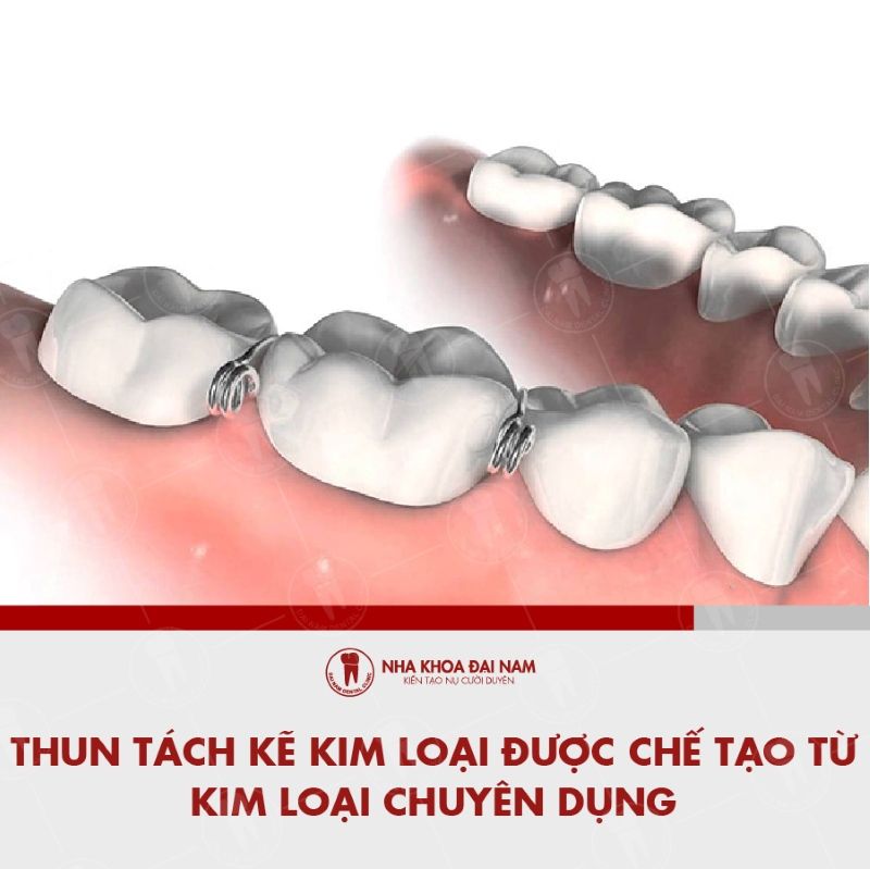 Thun tach ke kim loai duoc che tao tu kim loai chuyen dung